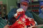 عمل جراحی سرطان پیشرفته معده در بیمارستان امام خمینی (ره) بناب