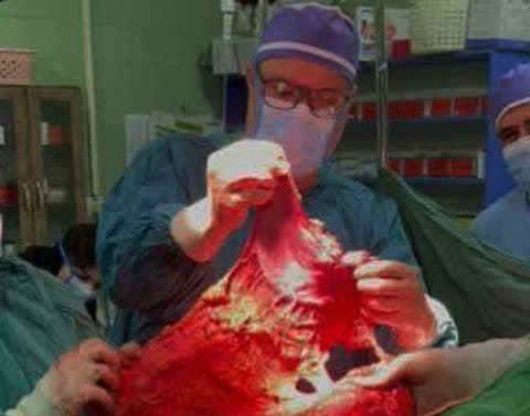 عمل جراحی سرطان پیشرفته معده در بیمارستان امام خمینی (ره) بناب